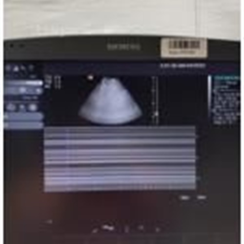 ACUSON SIEMENS S2000 ABVS Ultrasound System (293586)